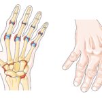 O que significa ter artrite?