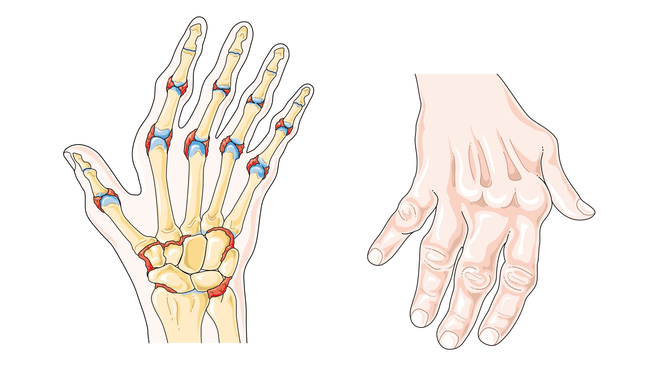 O que significa ter artrite?