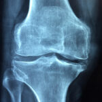 O que significa osteoporose?