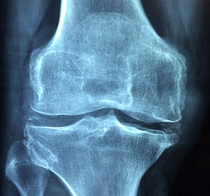 O que significa osteoporose?